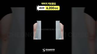 대용량 허벅지 지방흡입 전후