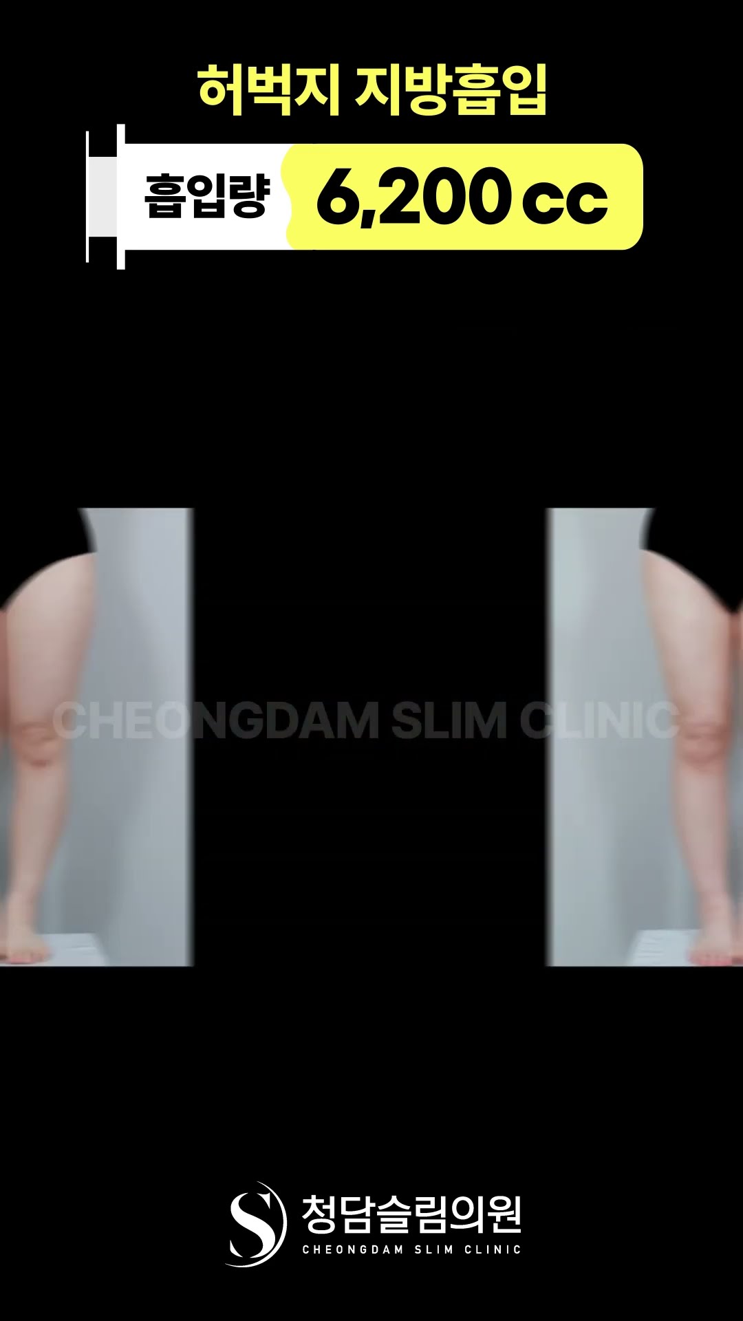 대용량 허벅지 지방흡입 전후