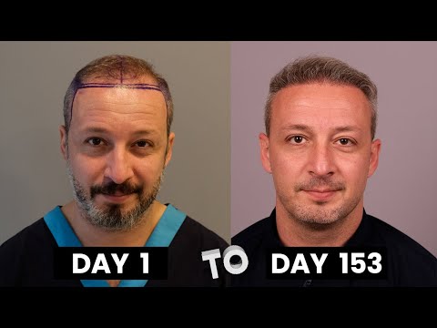 HAIR TRANSPLANT TIMELAPSE | DAY 1 TO DAY 153 | GROWTH...