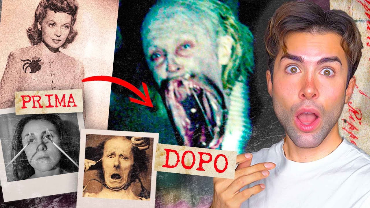 I PEGGIORI ESPERIMENTI DELLA STORIA: LOBOTOMIA | GIANMARCO ZAGATO