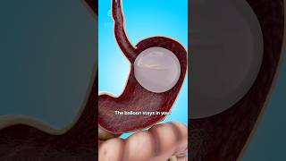 How a Gastric Balloon Helps with Weight Loss 😮 # shorts #viralvideo - Creativelearning3d