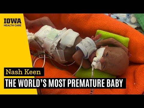 Iowa boy born at 21 weeks is now the world's most premature baby | UI Health Care