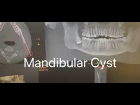 Case of Mandibular Cyst by Dr. Tatch