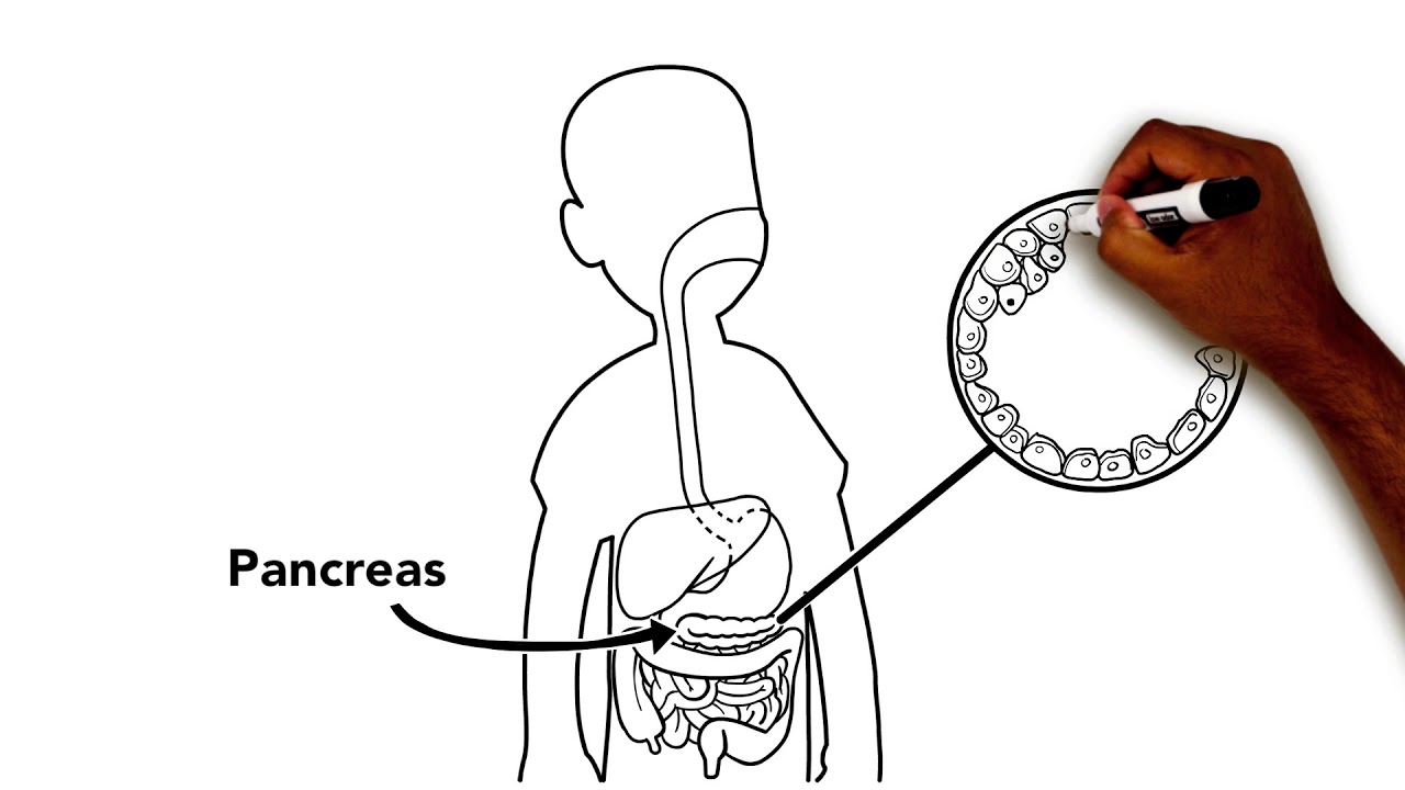 What is Diabetes?: Type 1 Diabetes Education from Phoenix Children's