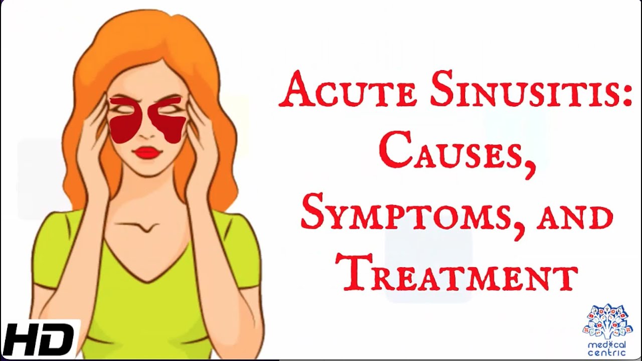 Acute sinusitis : Everything you need to know