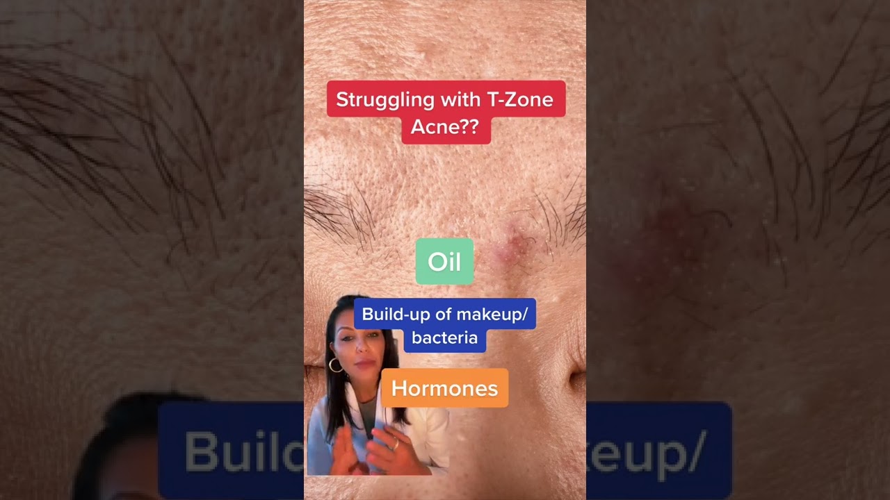 Watch video Struggling with t-zone acne || #shorts Now Struggling with t-zone acne || #shorts