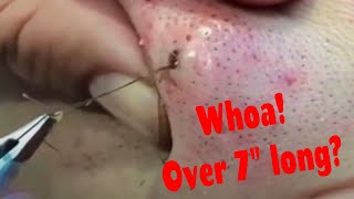 Hairy Situations! Ingrown hairs, infected follicles, pops + more