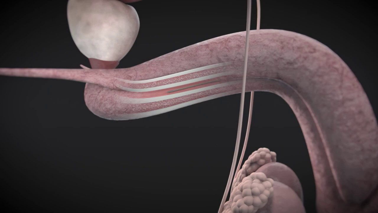 Watch Enucleación con láser de Holmio en el Centro de Próstata Clínica Universidad de Navarra Now Enucleación con láser de Holmio en el Centro de Próstata Clínica Universidad de Navarra