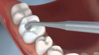 preview picture of video 'Middletown RI Dentist Shares Video Animation of Composite Tooth Colored Filling'