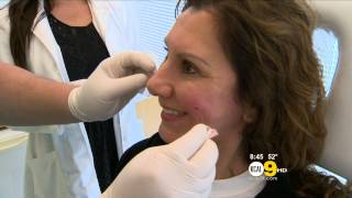 Dr. Garo Kassabian Lift Md Aesthetics: Liquid facelift with Voluma injection - KCAL
