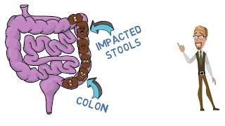 The effective treatment of childhood constipation according to NICE guidelines.