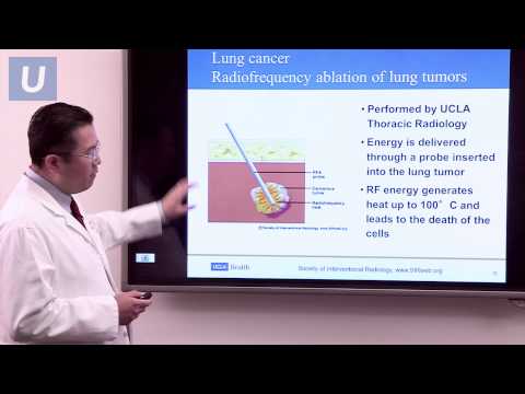 Treatment for Lung Cancer | Jay Lee, MD and Jonathan Goldman, MD | UCLAMDChat