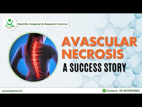 Stem Cell Treatment for Avascular Necrosis: Patient Success Story | StemRx.in