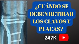 ¿CUÁNDO SE DEBEN RETIRAR LOS  MATERIALES  DE OSTEOSINTESIS