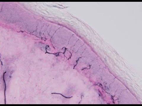 Small Fiber Neuropathy
