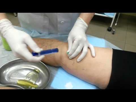 Лечение синовита коленного сустава (пункция)