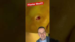 Download lagu AMAZING PLANTAR WART REMOVAL! 😱#shorts mp3 Download lagu AMAZING PLANTAR WART REMOVAL! 😱#shorts mp3