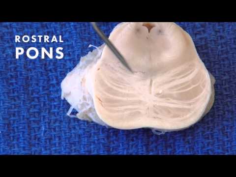 Sensation from the Body: Neuroanatomy Video Lab - Brain Dissections