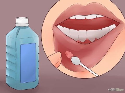 Putol na kuko sa paa sanhi at paggamot Propolis kuko halamang-singaw paggamot gamot