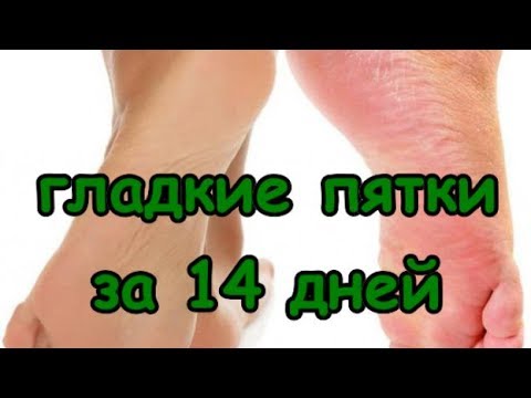Гладкие пятки,сухая кожа ног чем лечить