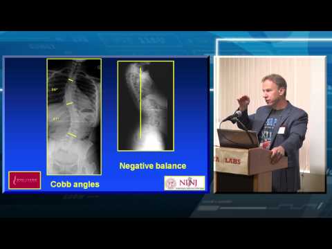 Spinal Deformity: Overview