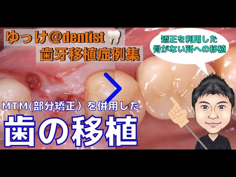 生命歯学科 【治療症例集】骨がない場所へも移植可能？矯正治療を併用した歯の移植術！インプラントをしなくてもご自身の歯で抜いた場所で噛めるようになる？！