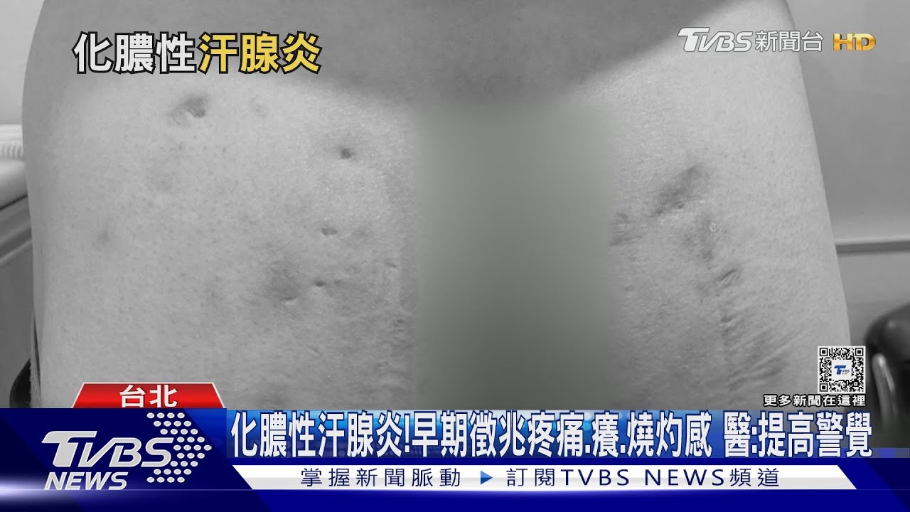 身體這「敏感部位」出現紅腫、囊腫、膿瘡 醫師:速就醫治療勿拖延
