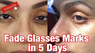 How I Removed My Glasses Marks In Only 5 Days!!! | DIY Spot Treatment