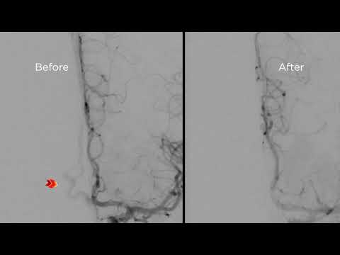 Commentary on a #cubitalfirst transvenous embolization of an ethmoidal dAVF