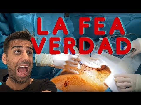 La FEA VERDAD sobre la Cirugia de Alargamiento y Engrosamiento de Pene