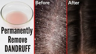 How to cure dandruff permanently naturally at home