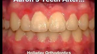 preview picture of video 'Orthodontics Salt Lake City UT Call (801) 278-7272'