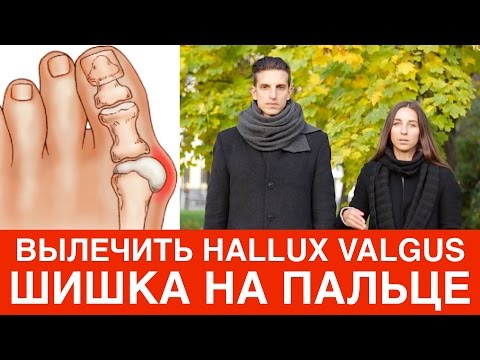 Strona internetowa przystanek krem gula Jak usunąć nierówności na stopie przy dużych środków toe ludowych