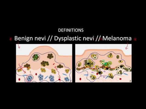 Introduction to Skin Cancer #3: Overview of Nevi and Melanoma