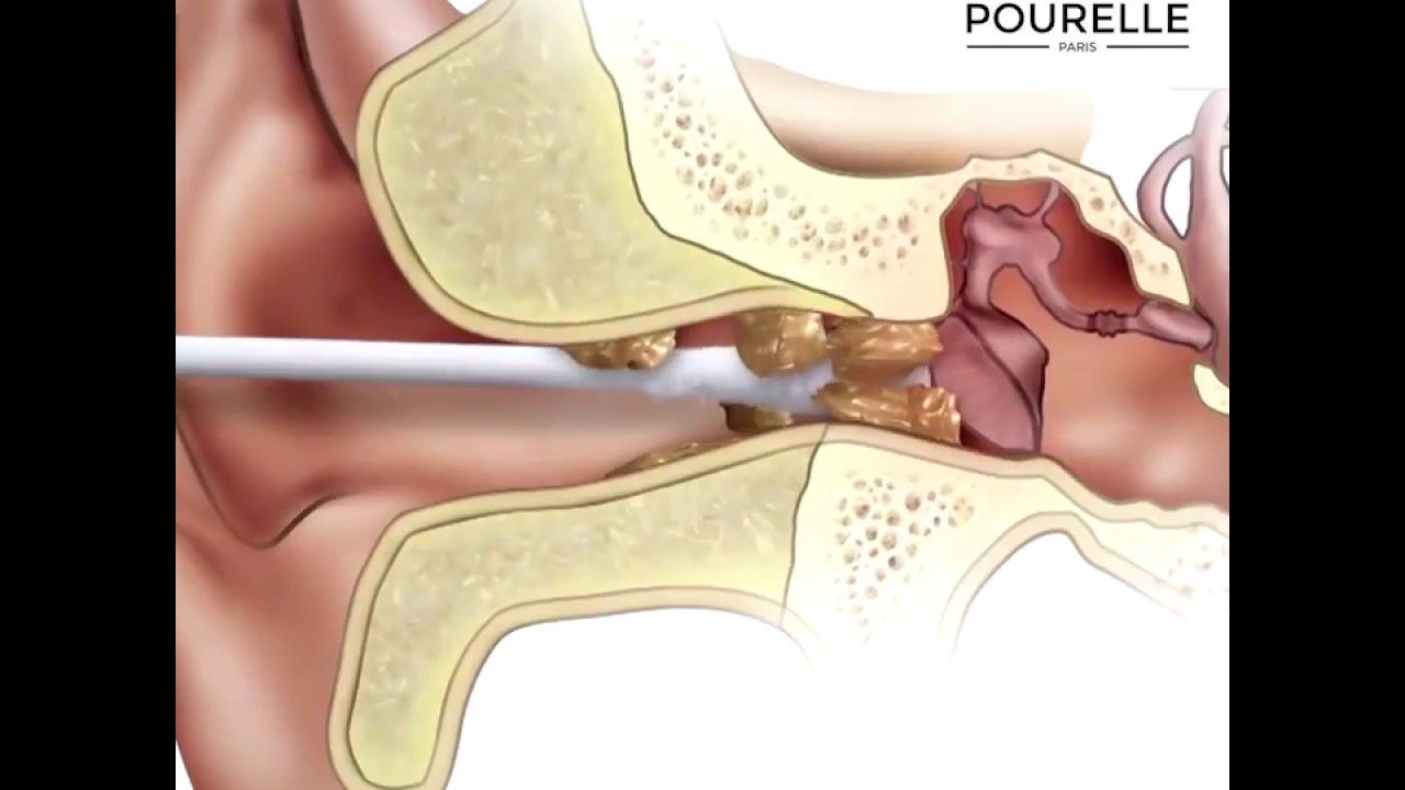 LA MEILLEURE METHODE POUR SE NETTOYER LES OREILLES !