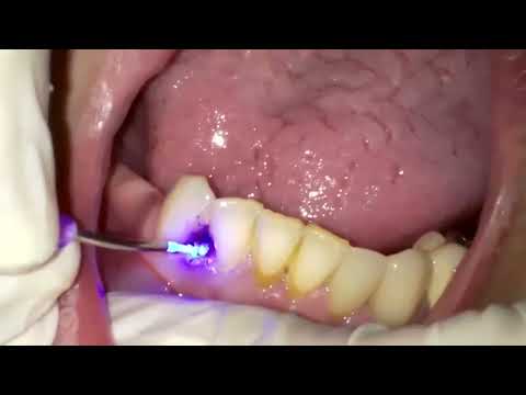 Gingivectomie laser – Parodontologie