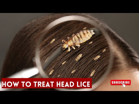 Head Lice treatment # lice in hair # head  lice removal