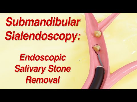 Submandibular Sialendoscopy: Endoscopic Salivary Stone Removal