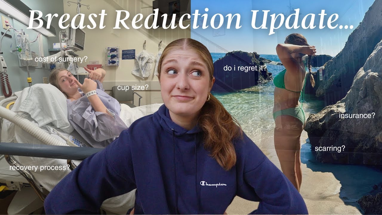 Breast Reduction Surgery UPDATE! (my thoughts one year post-op & answering questions)