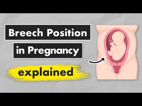 Breech Baby? Your Options Explained