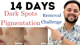 14 Days Dark Spots & Pigmentation Removal Challenge || 100% Results