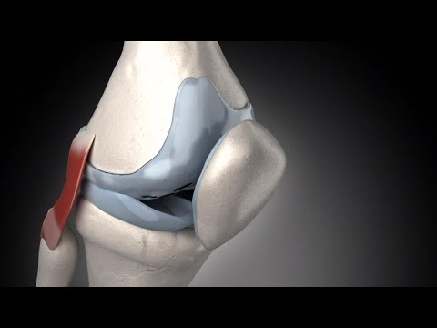 Unguent pentru durere în forul articulațiilor genunchiului