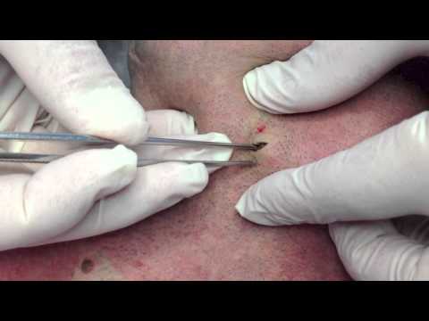 comment traiter kyste