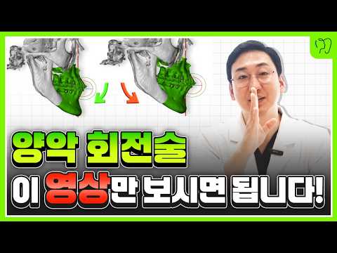 양악수술 회전? 역회전? 이 영상 한편으로 종결짓습니다!