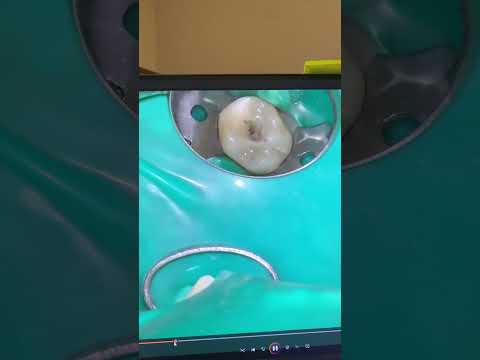 POV clinical video of root canal therapy of tooth #14 from start to finish.
