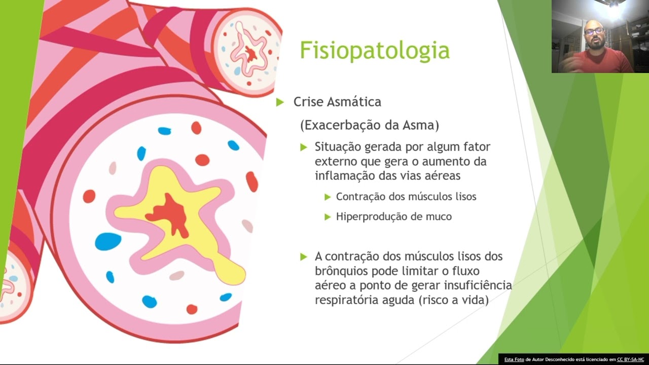 Asma - Etiologia, Fisiopatologia e Consequências Funcionais