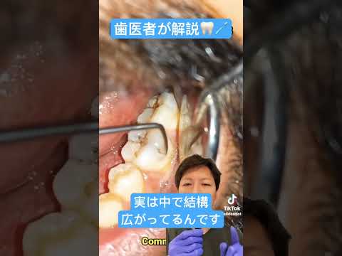 魅力的な!歯が生えた恐ろしい「怪物腫瘍」の正体はこれだ