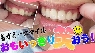 【セラミック矯正】上の歯+歯茎の施術でガミースマイル解消！サムネイル
