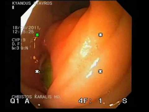 Duodenal Bleeding From Aortoduodenal Fistula. Aortic Graft
