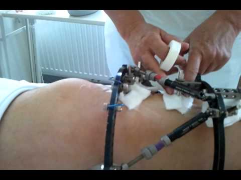 Uzi Knie in Perovo Behandlung der Gelenke bei der rheumatoiden Arthritis Heilanstalt